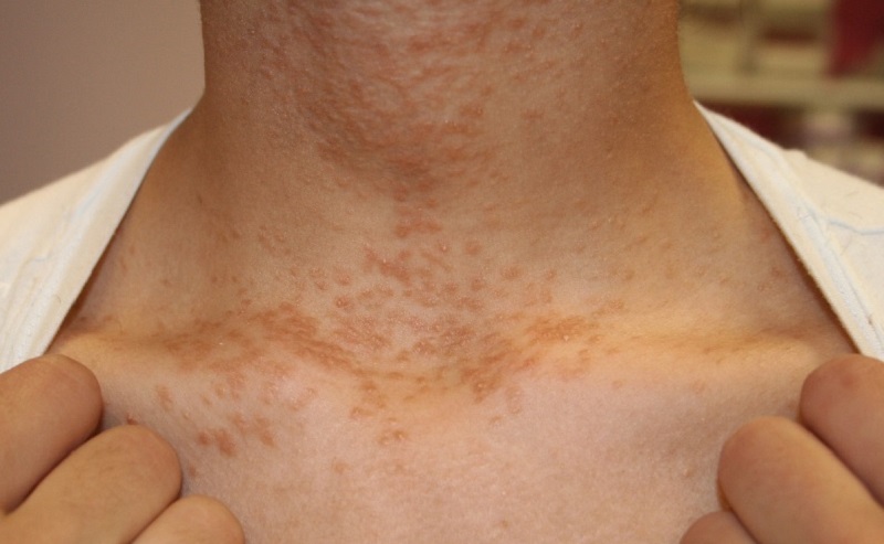 nổi mụn ở cổ