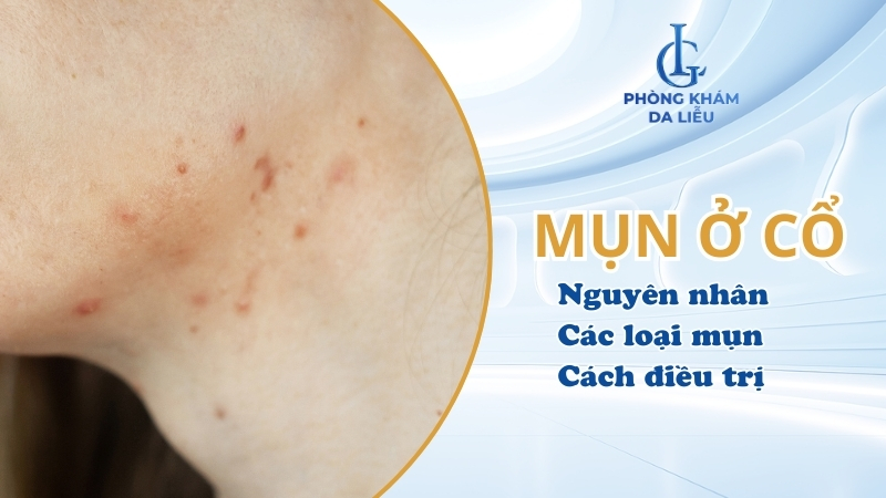 mụn ở cổ