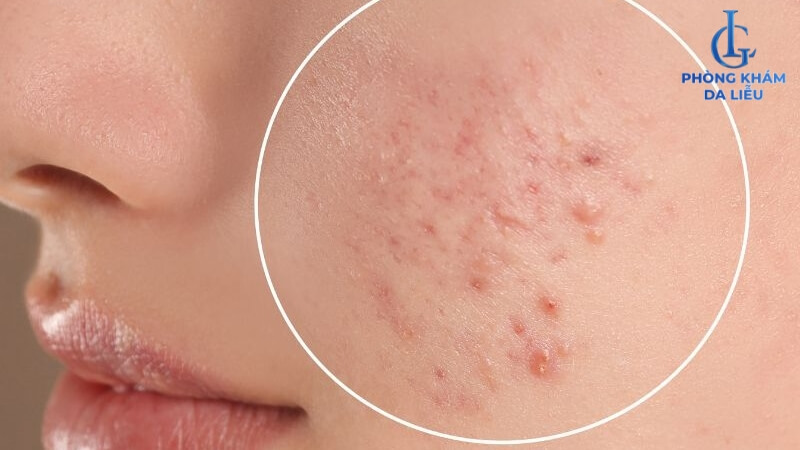 Mụn mọc ở má