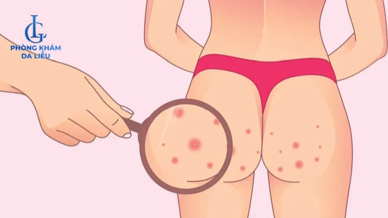 Hình ảnh nổi mụn ở mông