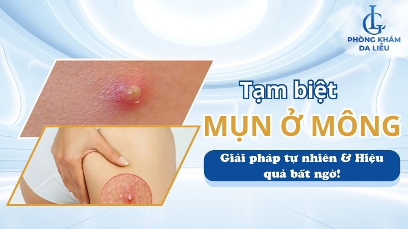 Mụn ở mông
