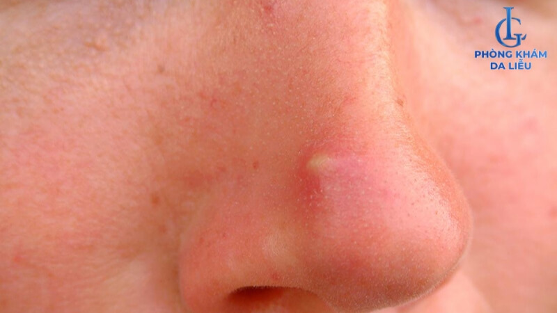 Mọc mụn ở mũi