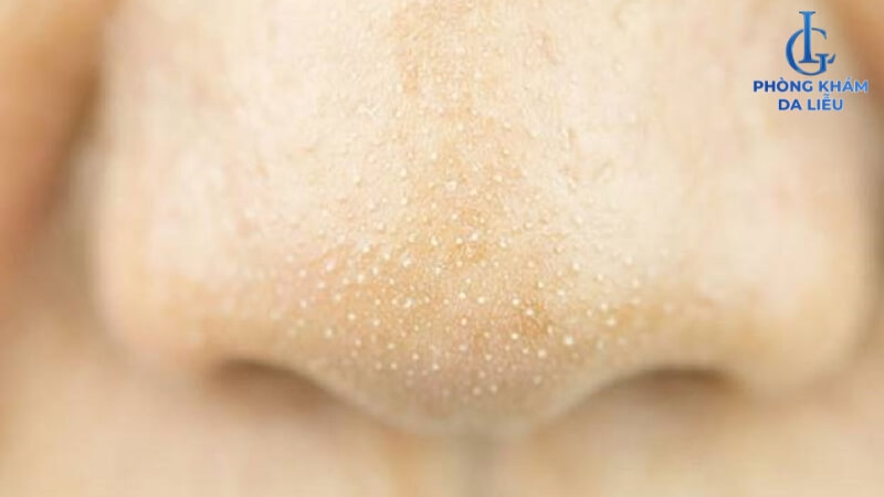 Mụn cám mọc ở mũi