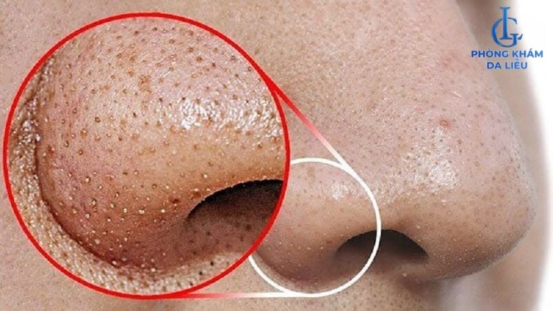 Mụn đầu đen ở mũi