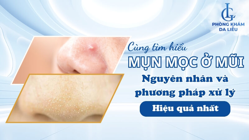 Mụn ở mũi