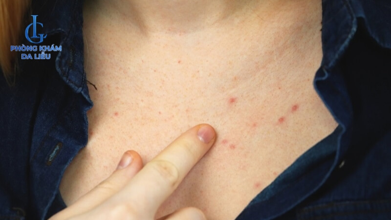 Nổi mụn ở ngực do rối loại Hormone