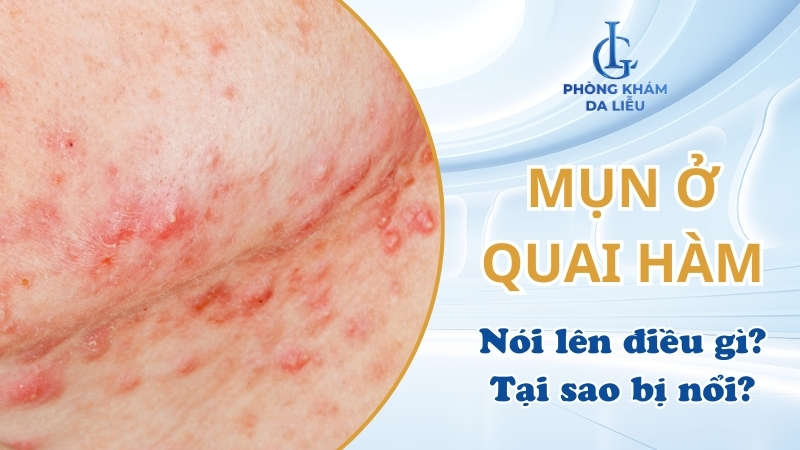 mụn ở quai hàm