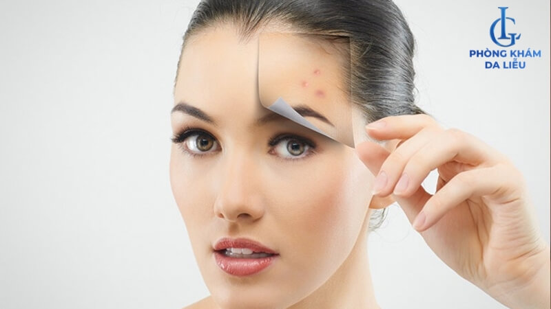 Nổi mụn ở trán nguyên nhân