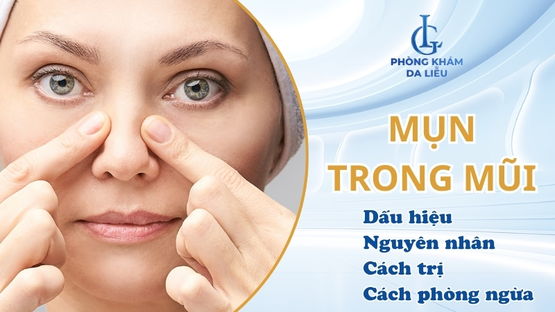 mụn trong mũi
