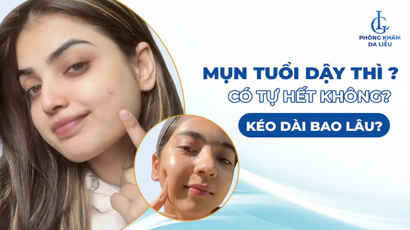 Mụn tuổi dậy thì có tự hết không