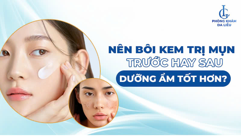 Nên bôi kem trị mụn trước hay sau dưỡng ẩm
