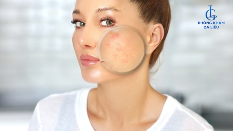 Peel da bị đẩy mụn