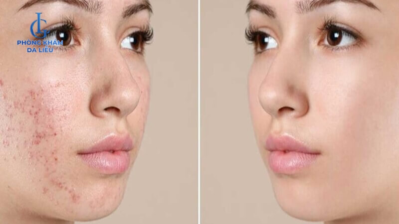 Peel da đẩy mụn