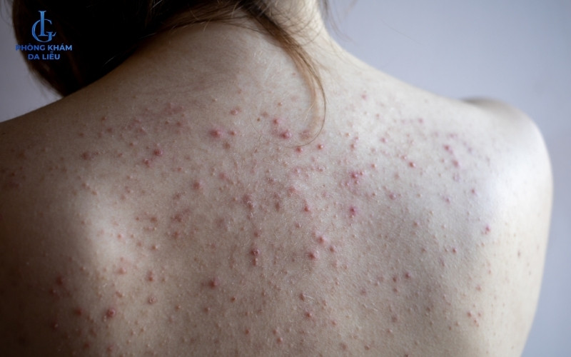 mụn lưng sưng đỏ
