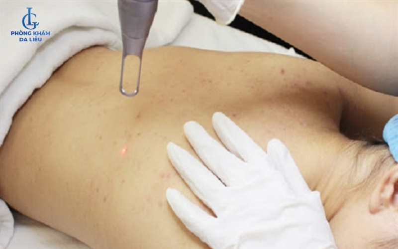 laser trị mụn lưng