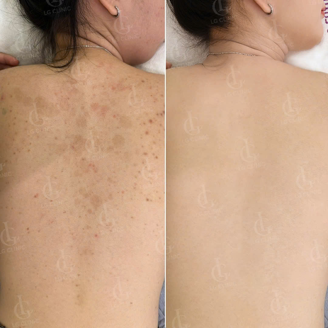 Hình trước và sau khi trị mụn lưng
