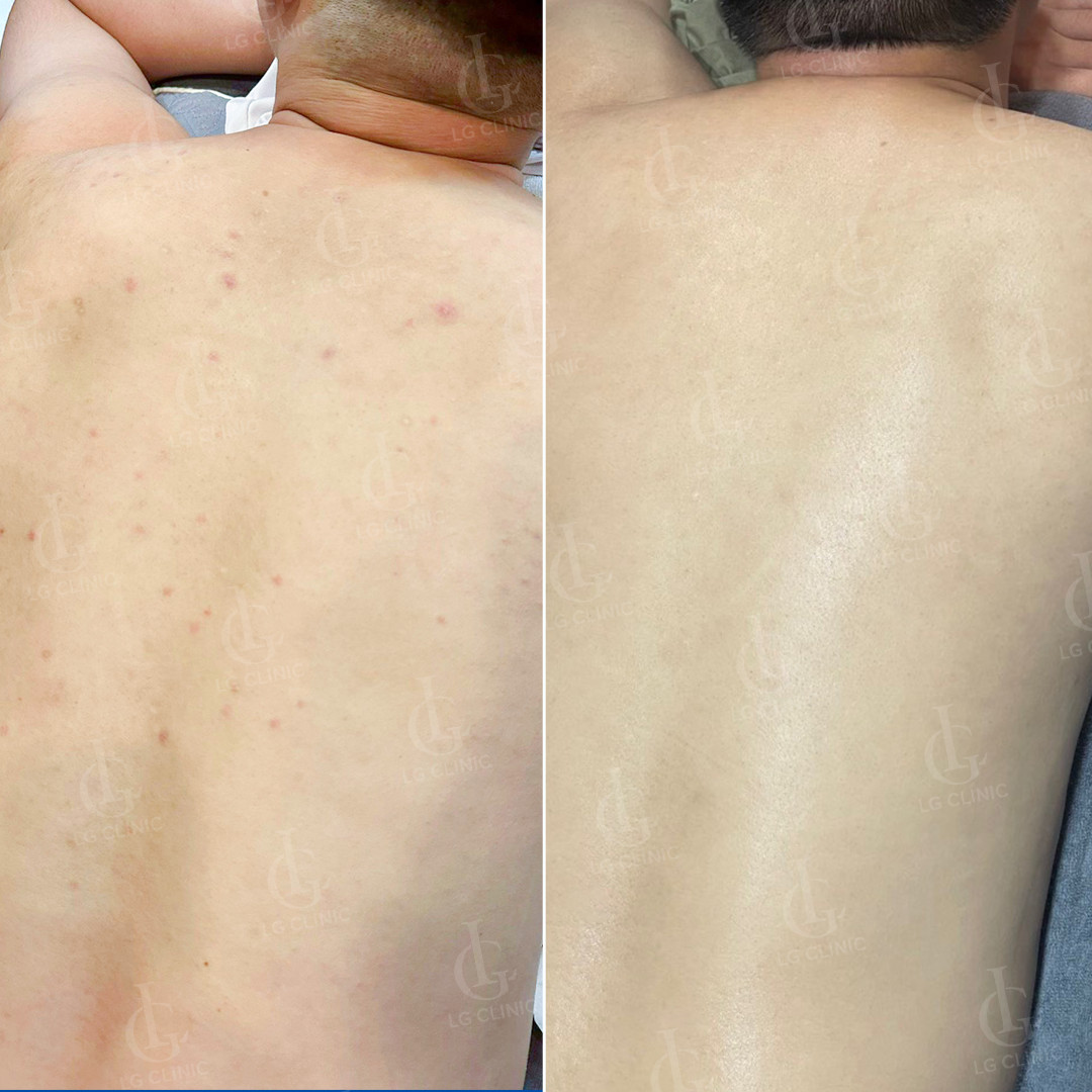 Hình trước và sau khi trị mụn lưng của nam giới