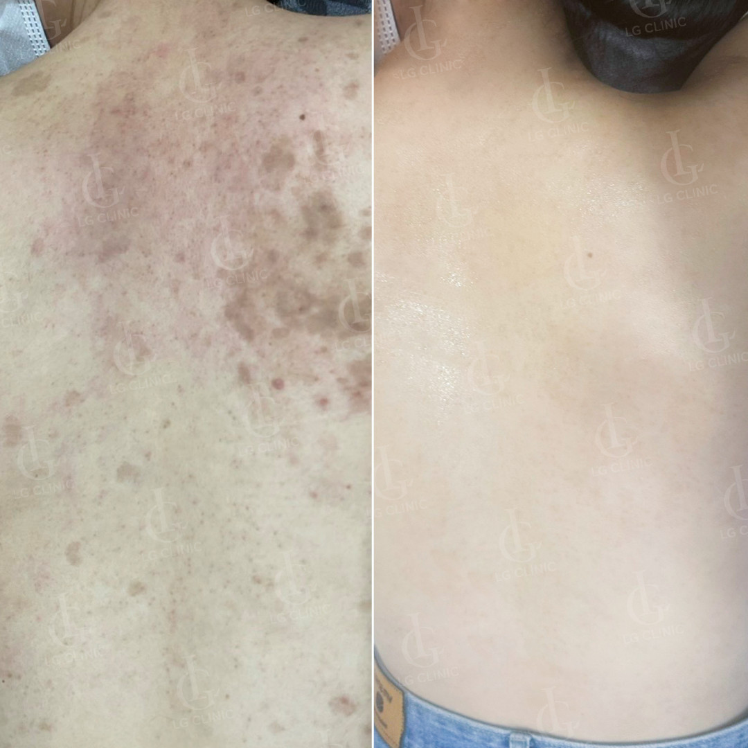 Hình trước và sau trị thâm mụn lưng