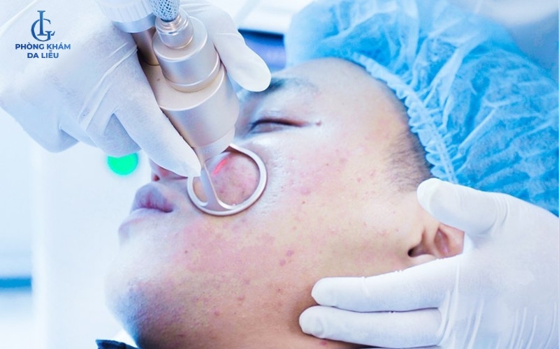 trị mụn doctor laser độc quyền