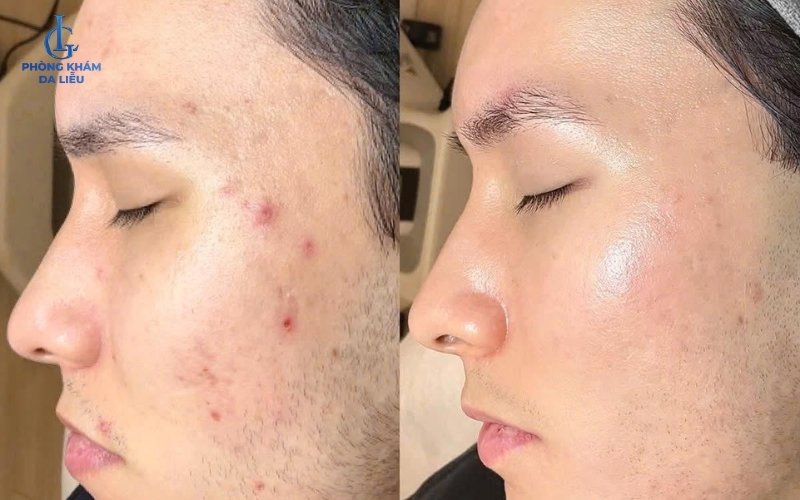 Hình 2: Hình ảnh trước và sau khi điều trị mụn mặt tại da liễu LG