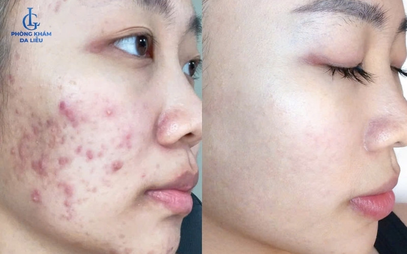 Hình 3: Hình ảnh trước và sau khi điều trị mụn mặt tại da liễu LG