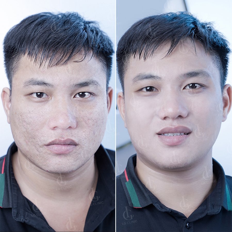 Hình trước và sau khi trị mụn bằng công nghệ doctor laser