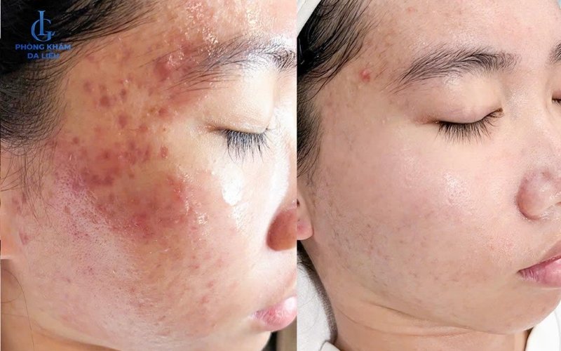 Hình 1: Hình ảnh trước và sau khi điều trị mụn mặt tại da liễu LG