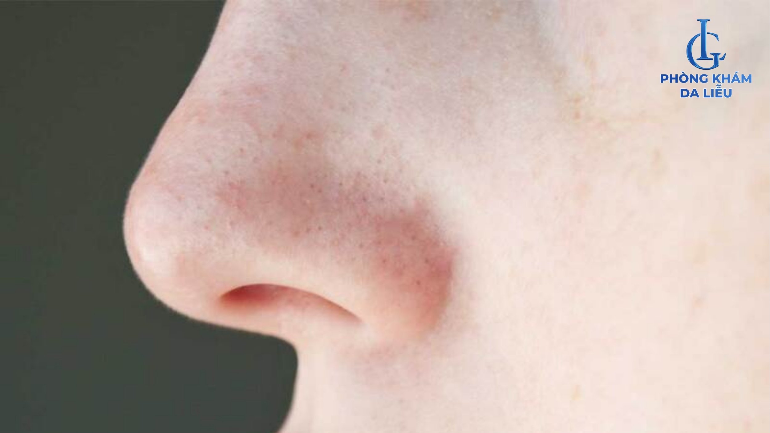 Bít tắc lỗ chân lông