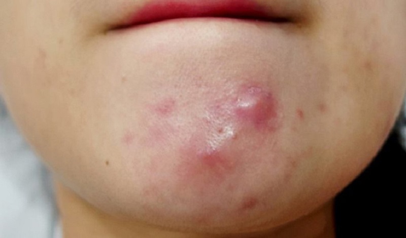 Mụn trứng cá ung