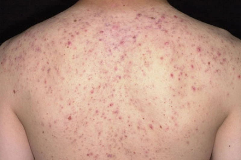 Nóng gan nổi mụn ở lưng