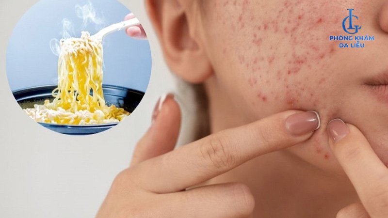 Ăn mì tôm có mọc mụn không?