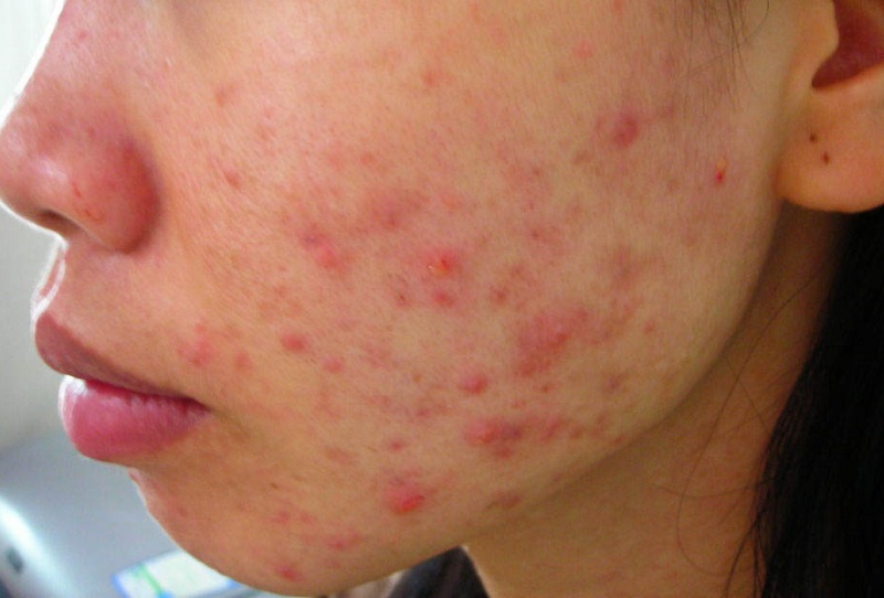 mụn đỏ