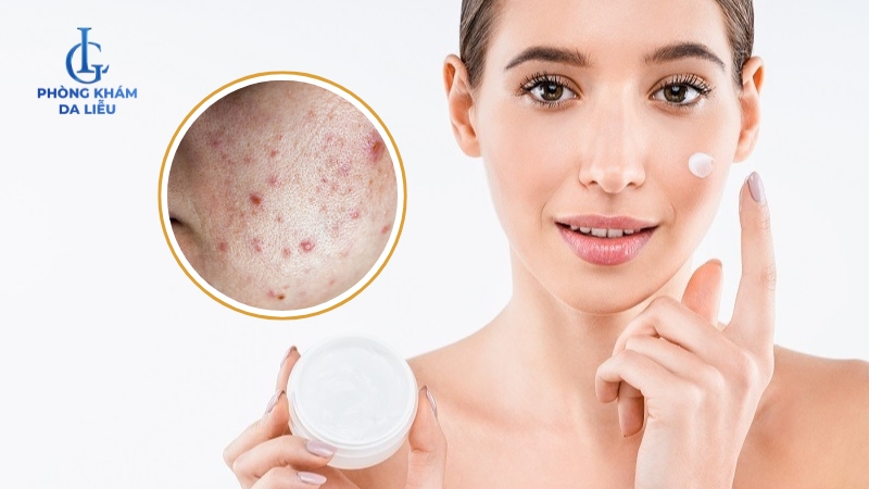 Dưỡng ẩm cho da có mụn trứng cá