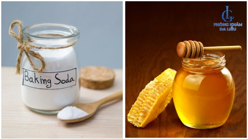 Baking soda và mật ong