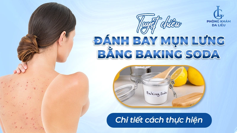 Cách trị mụn lưng bằng Baking Soda