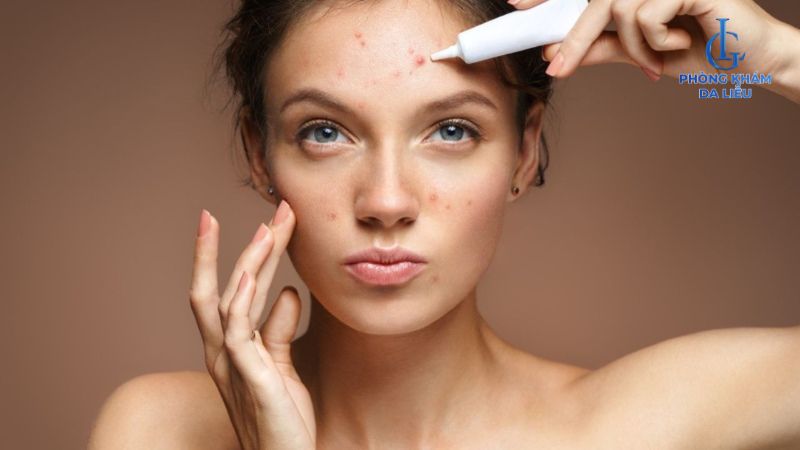 Benzoyl Peroxide và Axit Salicylic trị mụn trứng cá