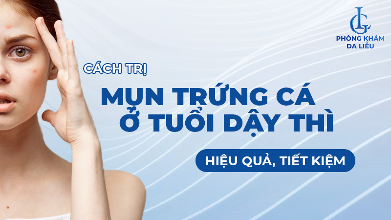 Cách trị mụn trứng cá tuổi dậy thì