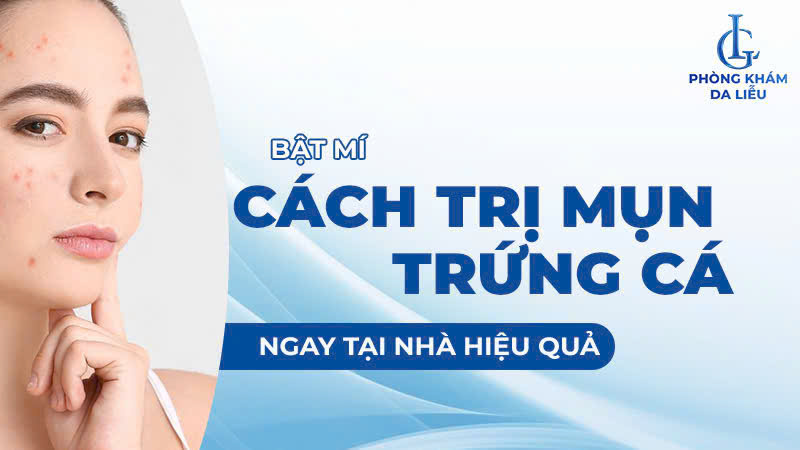 cách trị mụn trứng cá