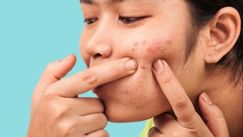 mụn trứng cá có nên nặn không​