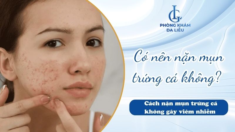 có nên nặn mụn trứng cá không