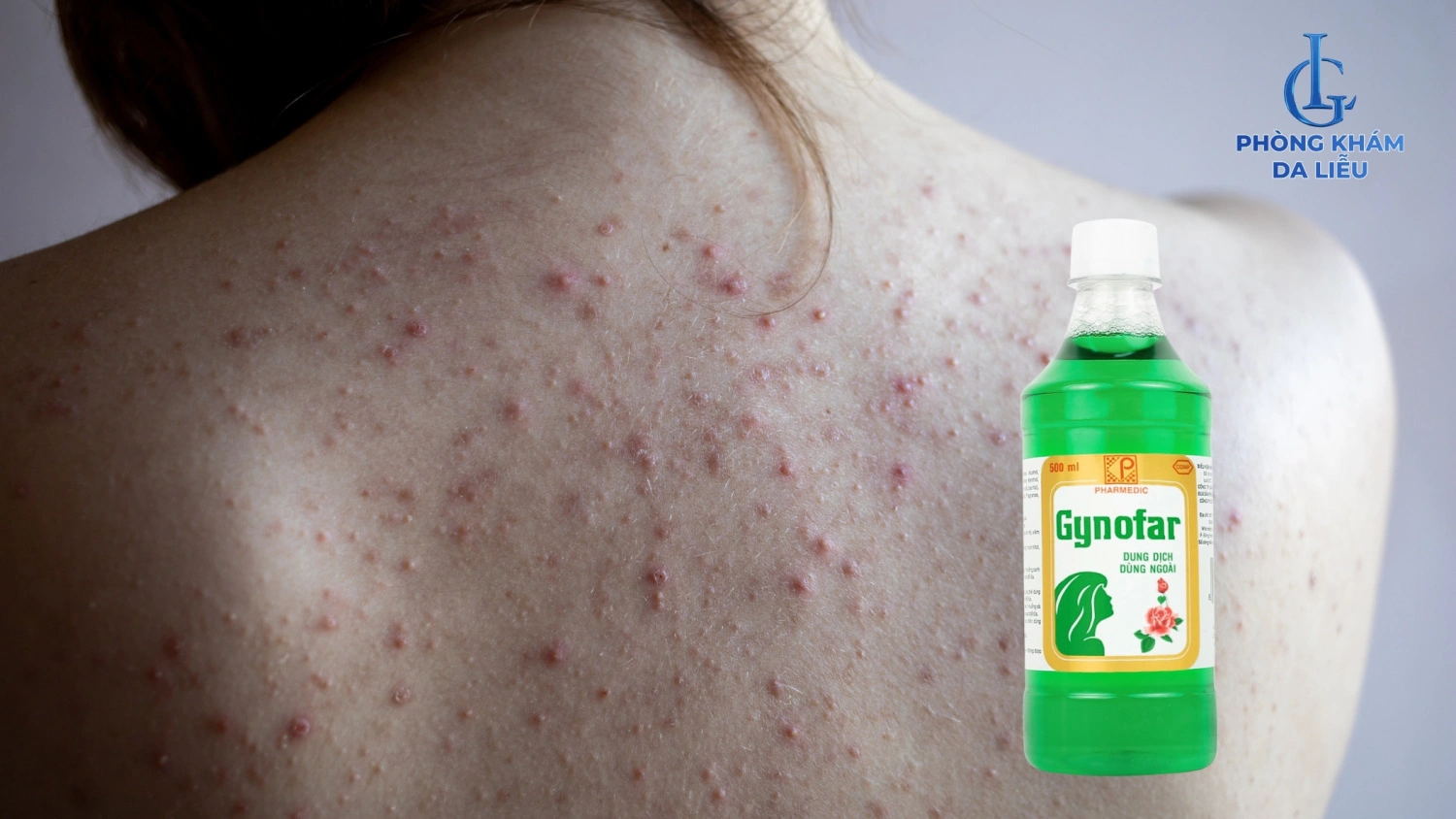 Dùng Gynofar trị mụn lưng 