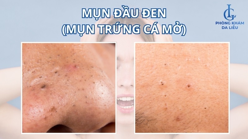Hình ảnh mụn đầu đen trên mũi và trán