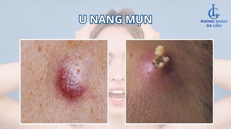 u nang mụn