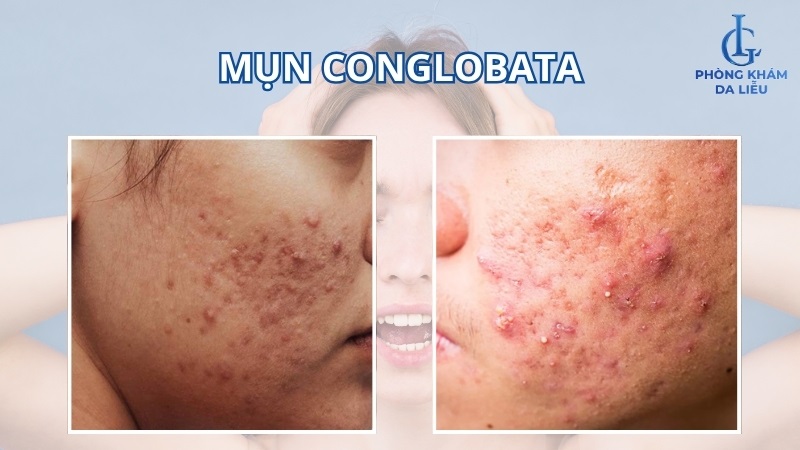 mụn conglobata