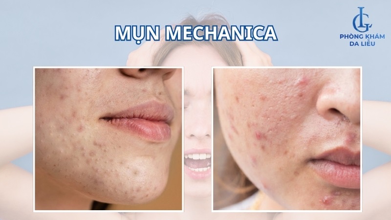 mụn Mechanica