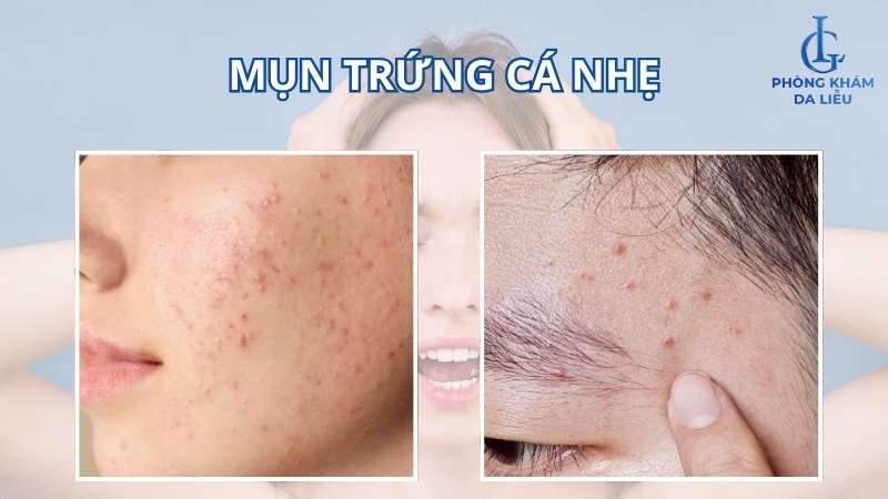 mụn trứng cá nhẹ