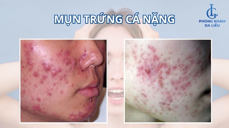 mụn trứng cá nặng