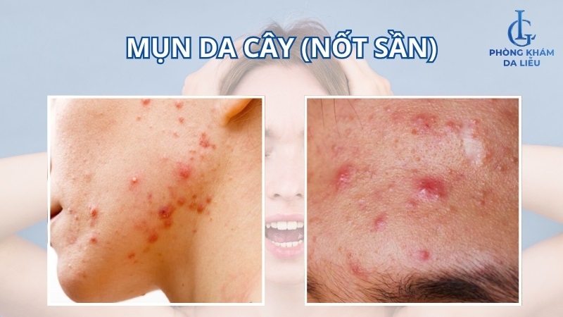 mụn da cây
