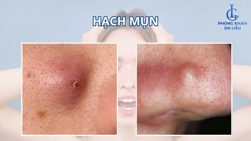 hạch mụn