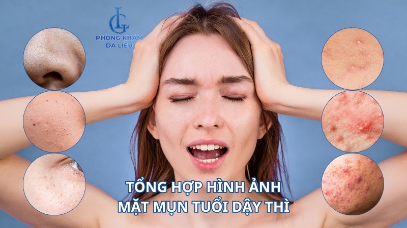 hình ảnh mặt mụn tuổi dậy thì​